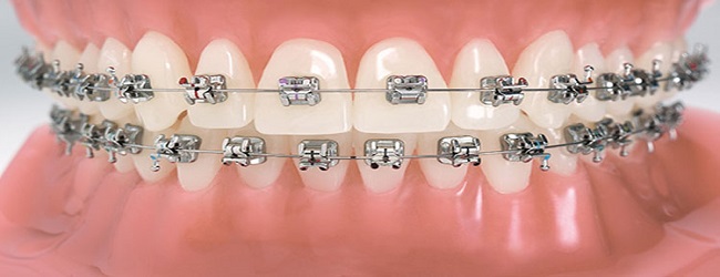 Orthodontic Braces