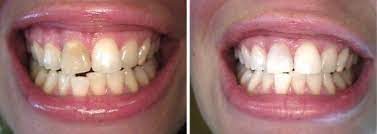 before and after root canal